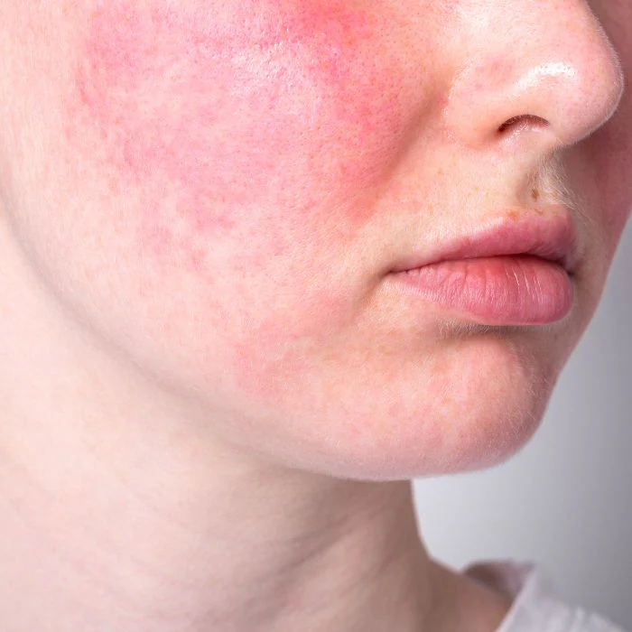 Close-up of a cheek flushed red with reactive, inflamed skin