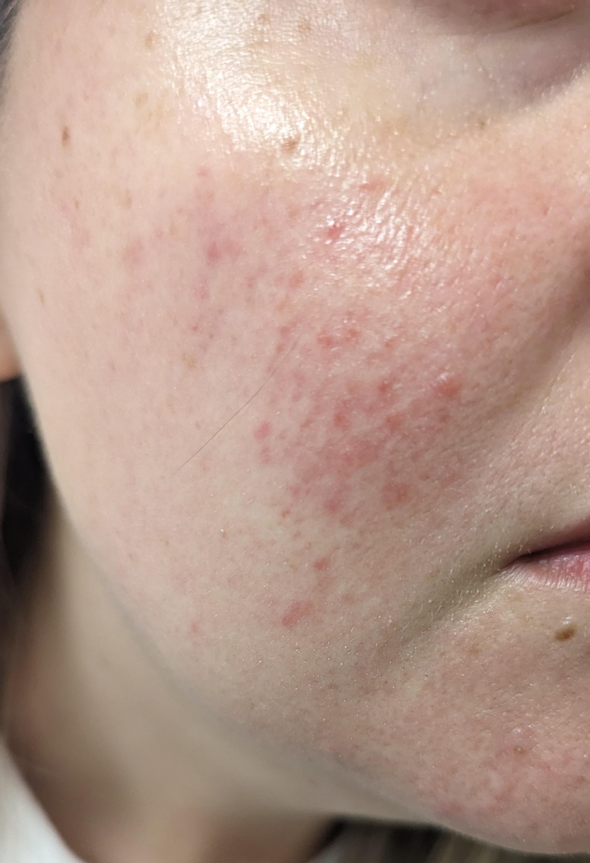 Close-up of a cheek with scattered red bumps and irritation